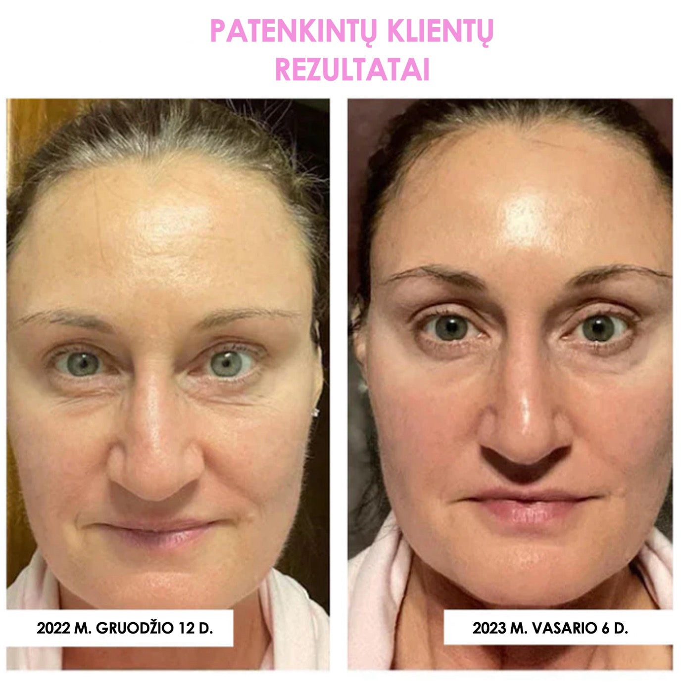 Lovids™ Korėjietiška Paakių Kaukė Su Kolagenu